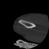 SPORK, NICO - 22.03.1976 - 02.08.2022 - CT obere Extremität - 17:51:17